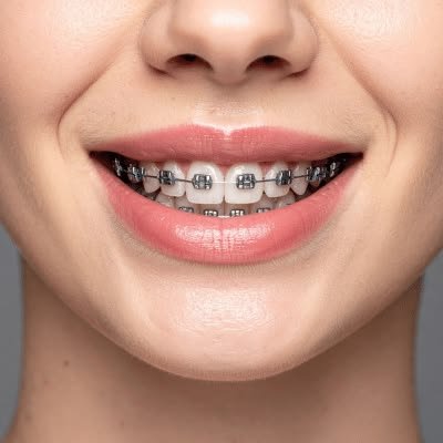 Dental Braces at Dental Universe, Kestopur