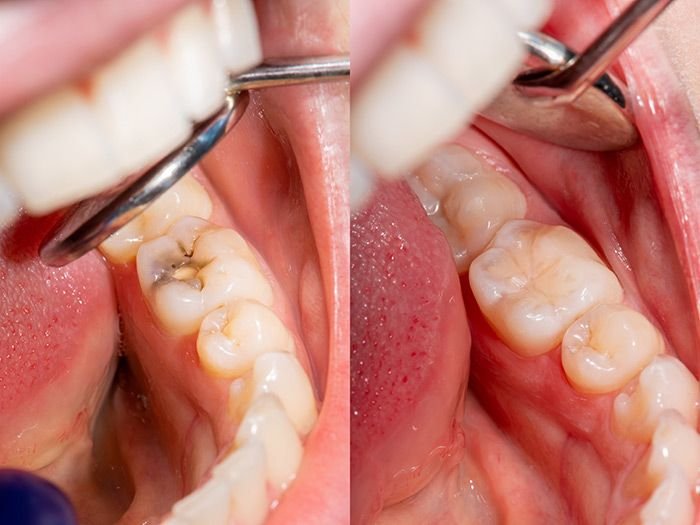 Dental Fillings at Dental Universe, Kestopur