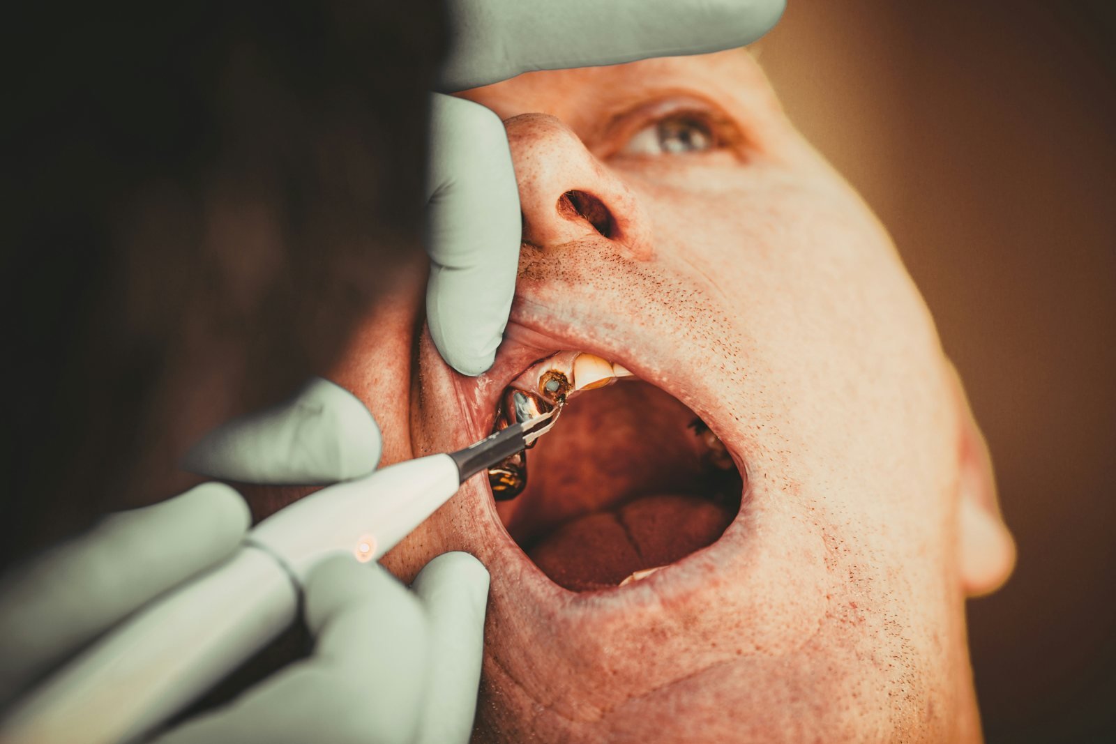 Dental Implants at Dental Universe, Kestopur