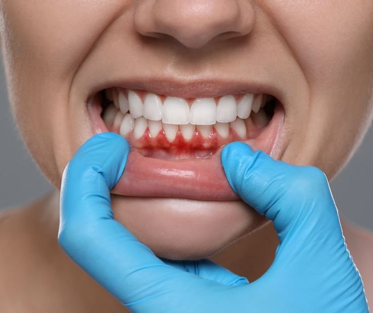 Gum Disease Treatment at Dental Universe, Kestopur