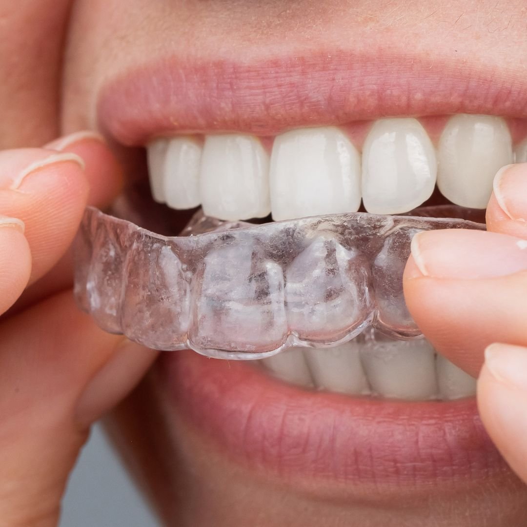 Invisalign at Dental Universe, Kestopur