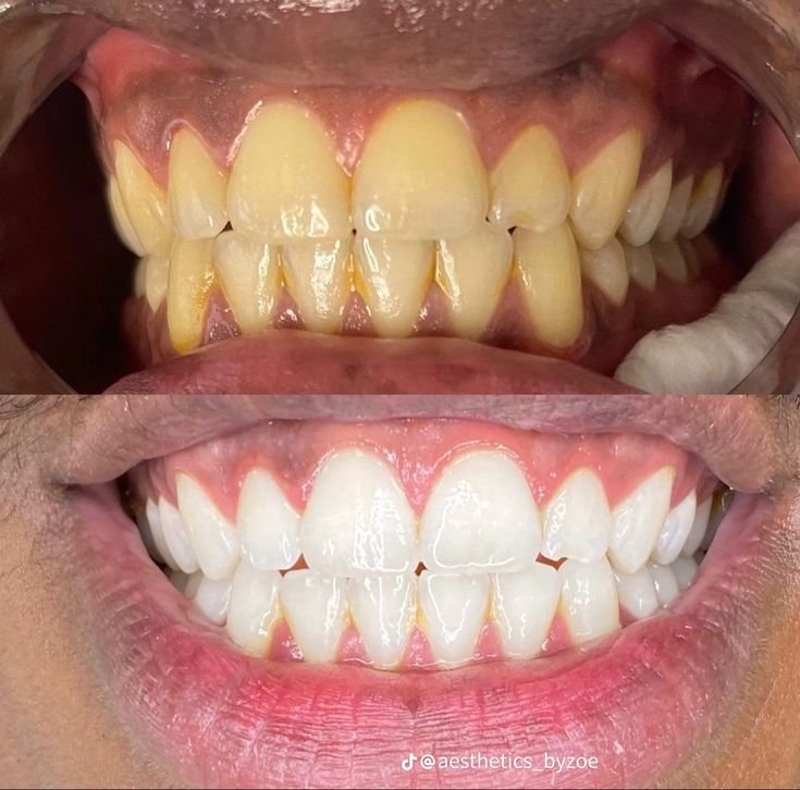 Teeth Whitening at Dental Universe, Kestopur