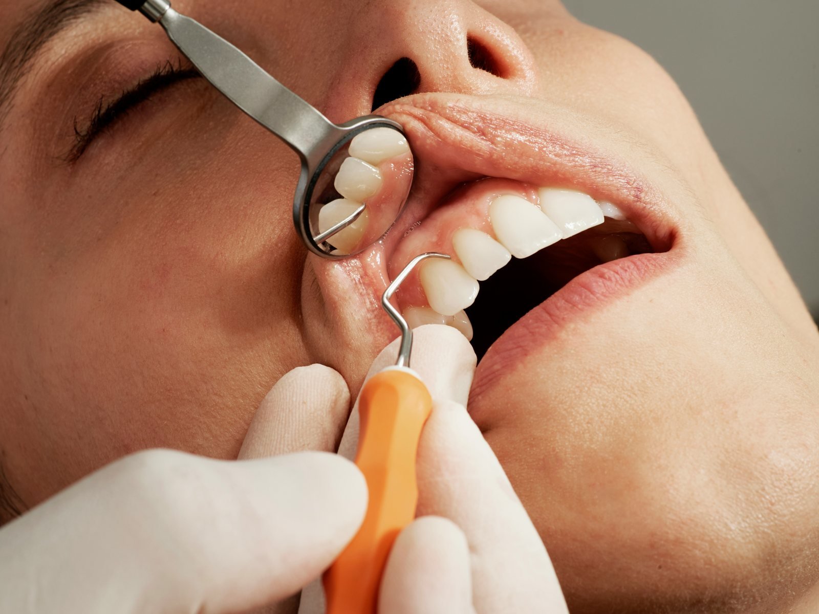 Wisdom Tooth Removal at Dental Universe, Kestopur
