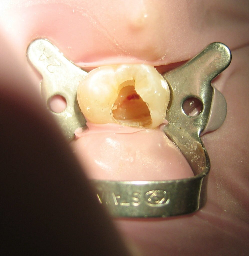 Root Canal vs Tooth Extraction in Kestopur: 7 Smart Facts!