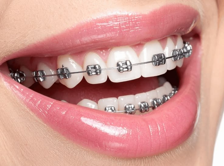 Braces in Salt Lake: 7 Proven Tips for a Straighter Smile!